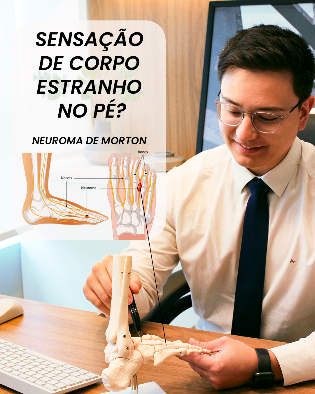 Já sentiu aquela sensação incômoda, como se houvesse uma pedrinha te incomodando dentro do sapato? 😫 Se a resposta for sim, é possível que você esteja lidando com o neuroma de Morton. Essa condição, que afeta os pés, pode causar dor intensa, queimação e até mesmo formigamento, especialmente na região dos dedos. 😖